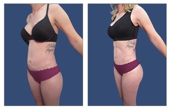 Liposuction (ดูดไขมัน) can provide again your body in certain months