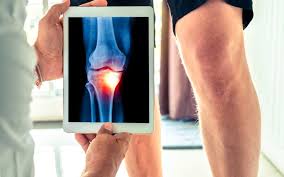 The Value Of Exactech Knee Recall Lawyer
