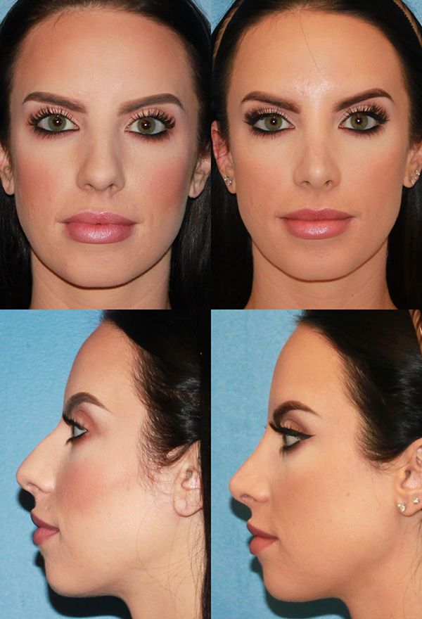 Liquid nose job Beverly Hills is an easy and risk-free reshaping treatment