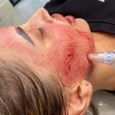 How PRP Facial Treatment Enhances Skin Texture and Natural Radiance